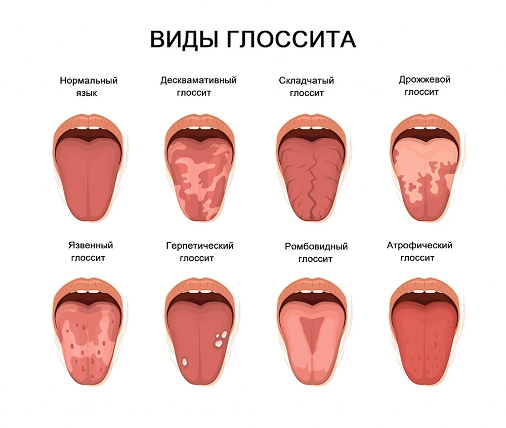 Десквамативный кандидозный глоссит