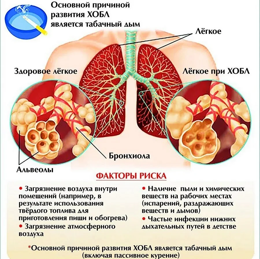 Патологические заболевания легких. При хронической обструктивной болезни легких. Основная причина развития хронической обструктивной болезни легких.