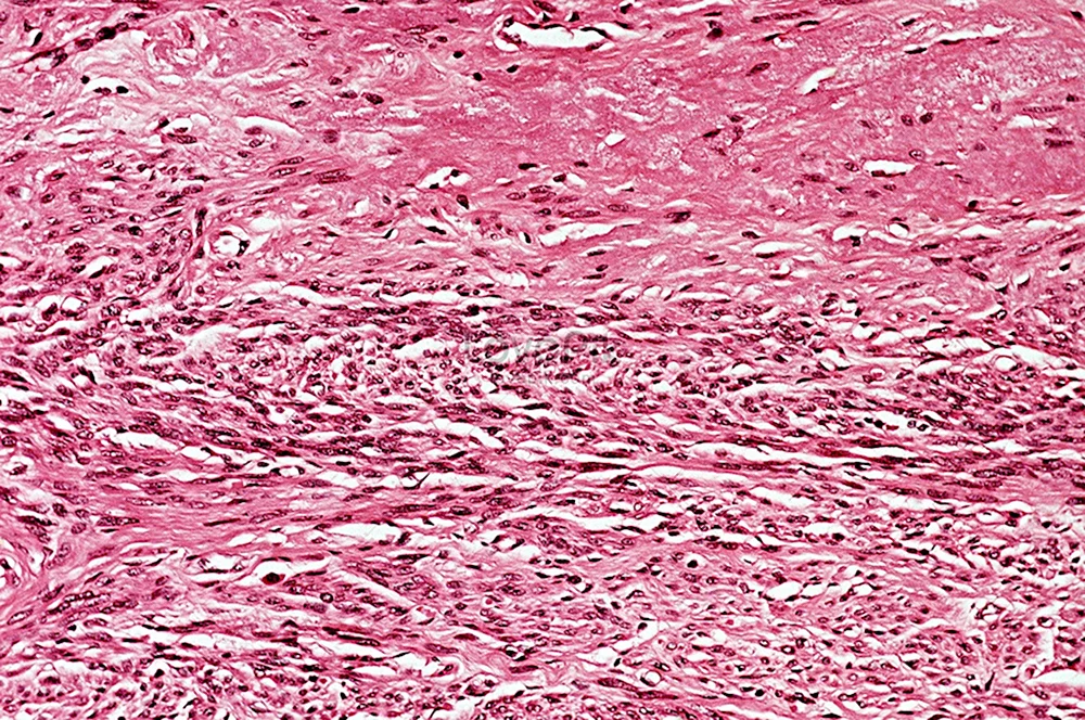 Фибросаркома матки гистология