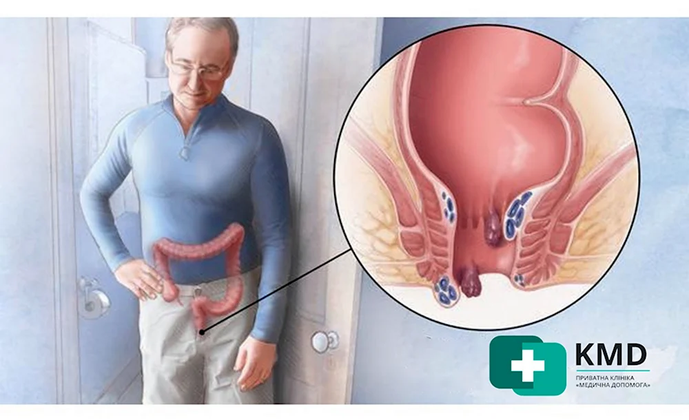 Геморрой последняя стадия