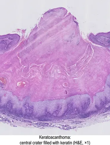 Кератоакантома гистология