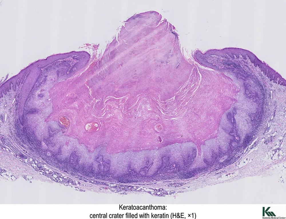 Кератоакантома гистология