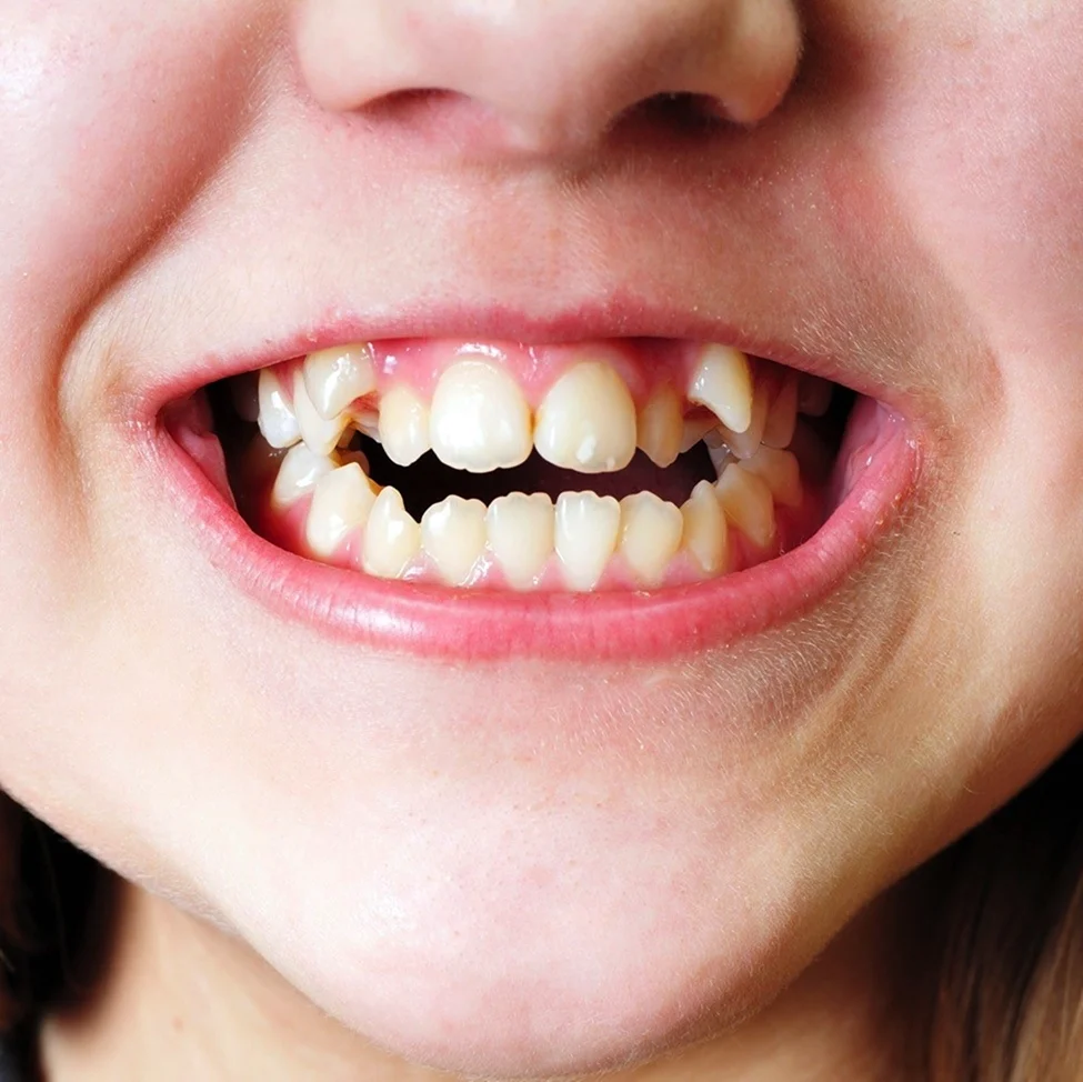 Кривые зубы неправильный прикус