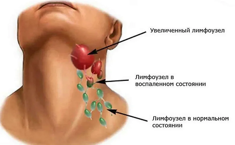 Лимфогранулематоз лимфоузлов