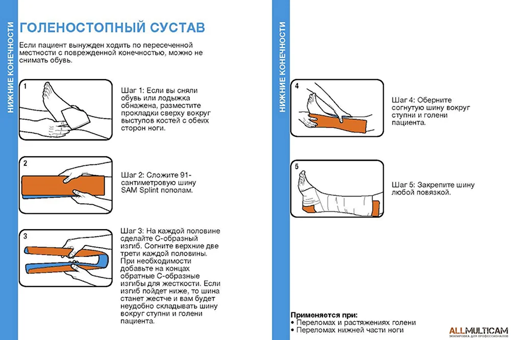 Наложение шины на голеностопный сустав