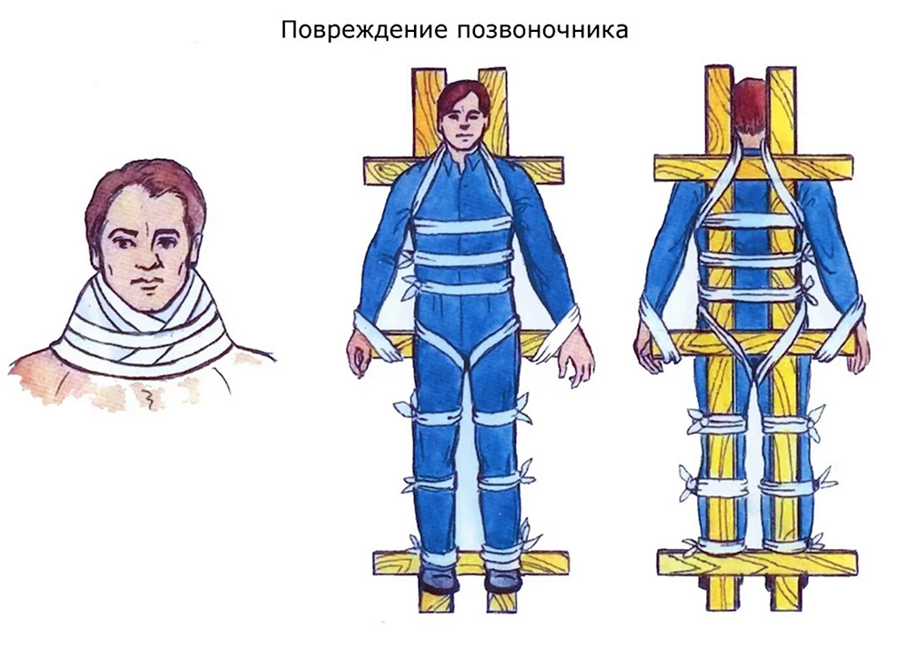 Наложение шины при переломе позвоночника