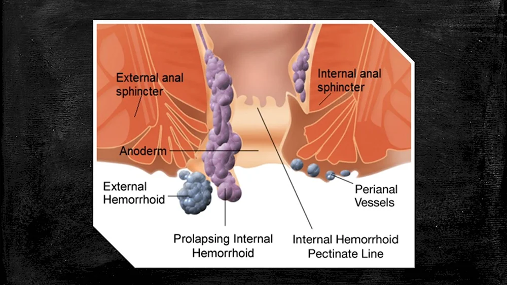 Наружный и внутренний геморрой