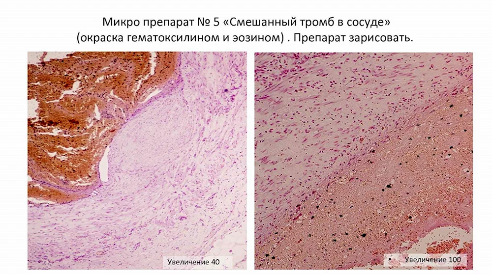 Организованный тромб в Вене микропрепарат