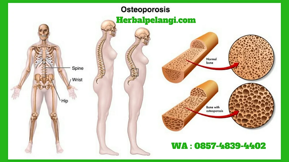 Остеопороз кость