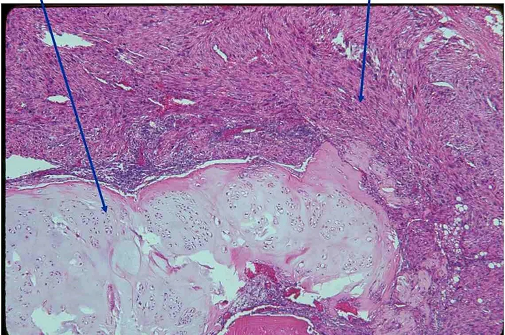 Остеосаркома гистология