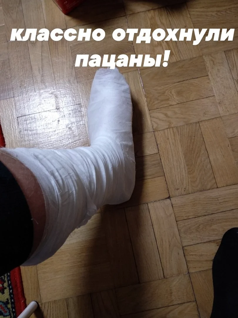 Смешные переломанные ноги