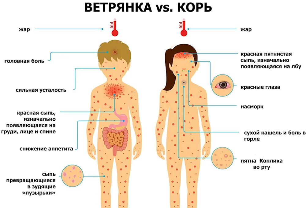 Через сколько заболевают корью после контакта. Ветрянка корь краснуха различия сыпи. Сыпь корь краснуха сыпь. Корь краснуха ветряная оспа сыпь. Высыпания корь краснуха ветрянка.