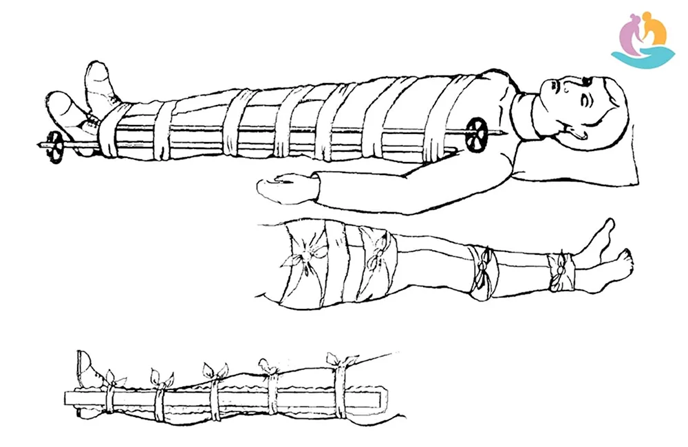 Транспортная иммобилизация конечности при переломе бедра