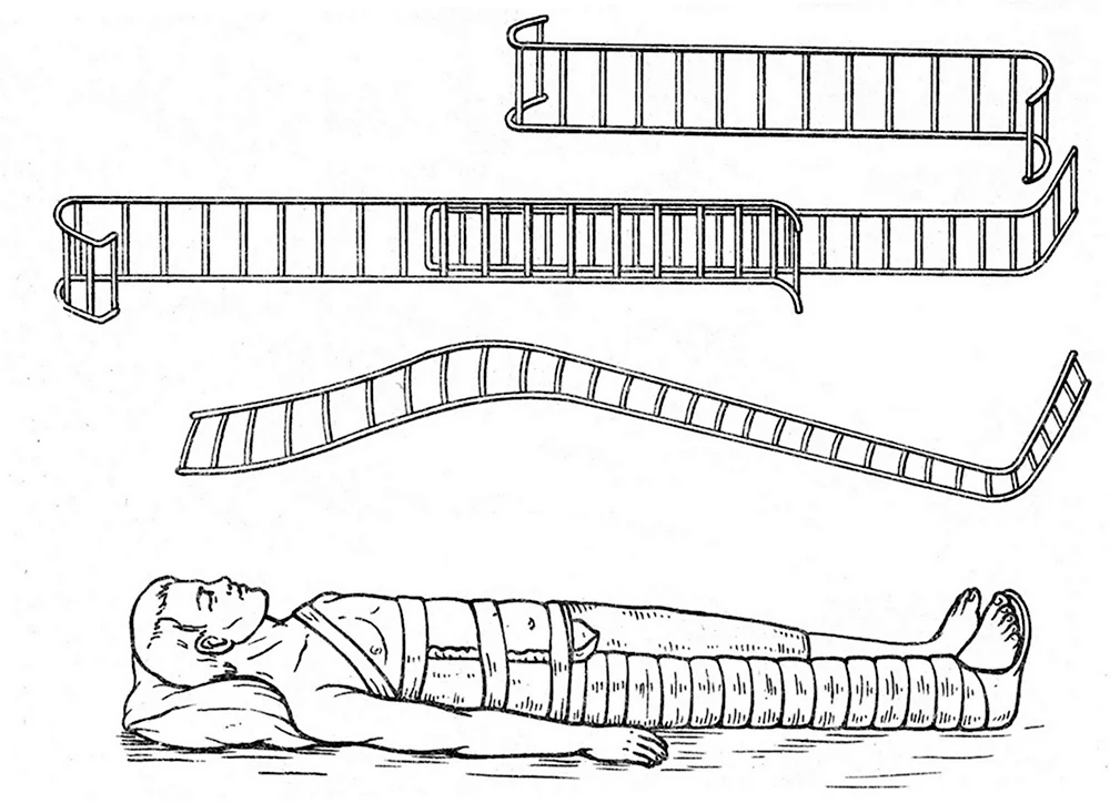 Транспортная иммобилизация шинами Крамера при переломах бедра