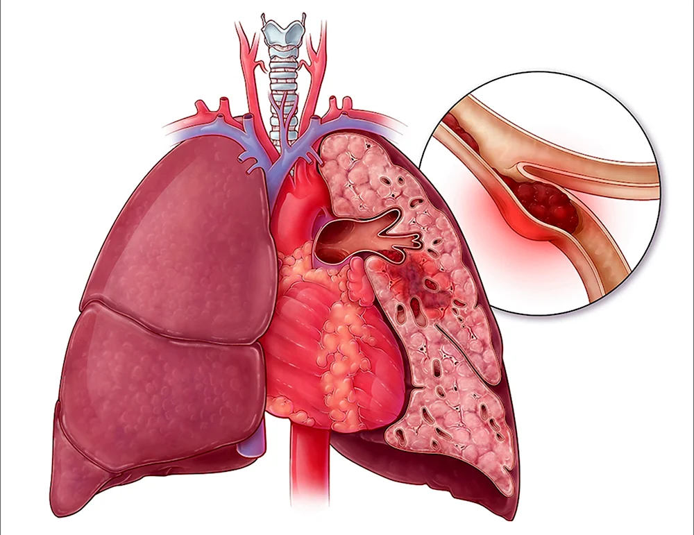 Тромбоэмболия легочной артерии