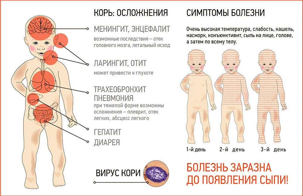 Вирусная экзантема и розеола