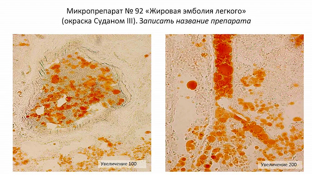 Жировая эмболия сосудов легкого микропрепарат